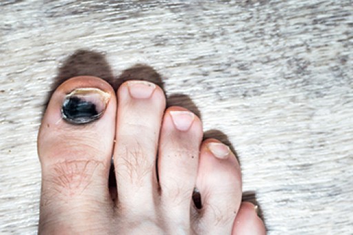 Toe Pain