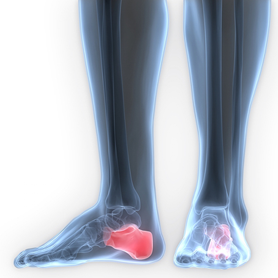 Stress Fractures in the Heel